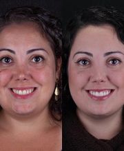 Lente de Contato Dental, Dr. Marcelo Borille imagen 14