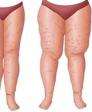 Medical Aesthetic Fettabsaugen Dr. Urs Benz Bild 5