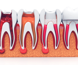 Endodoncia.png