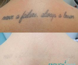 ENDLICH OHNE Tattooentfernung Filiale Dresden/Pirna Bild 4