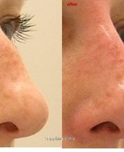 Rhinoplastie médicale