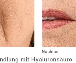 Faltenbehandlung mit Hyaloron
