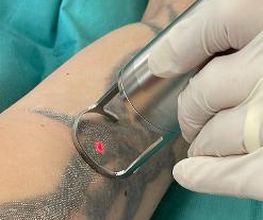 ENDLICH OHNE Tattooentfernung Filiale Wolfenbüttel Bild 1