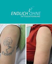 ENDLICH OHNE Tattooentfernung Filiale Heilbronn Bild 13