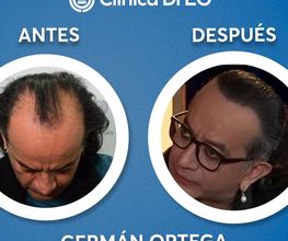 Clinica DrEO - Injerto de Cabello y Barba imagen 6