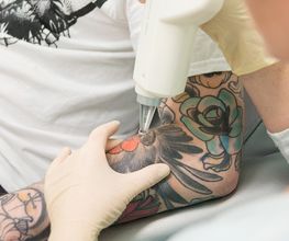 ENDLICH OHNE Tattooentfernung Filiale Köln Bild 3