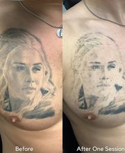 Removery Tattoo Removal & Fading image 3