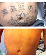Removery Tattoo Removal & Fading image 2