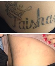 Removery Tattoo Removal & Fading image 8